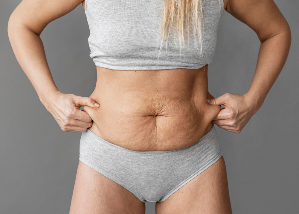 abdominoplastia estendida