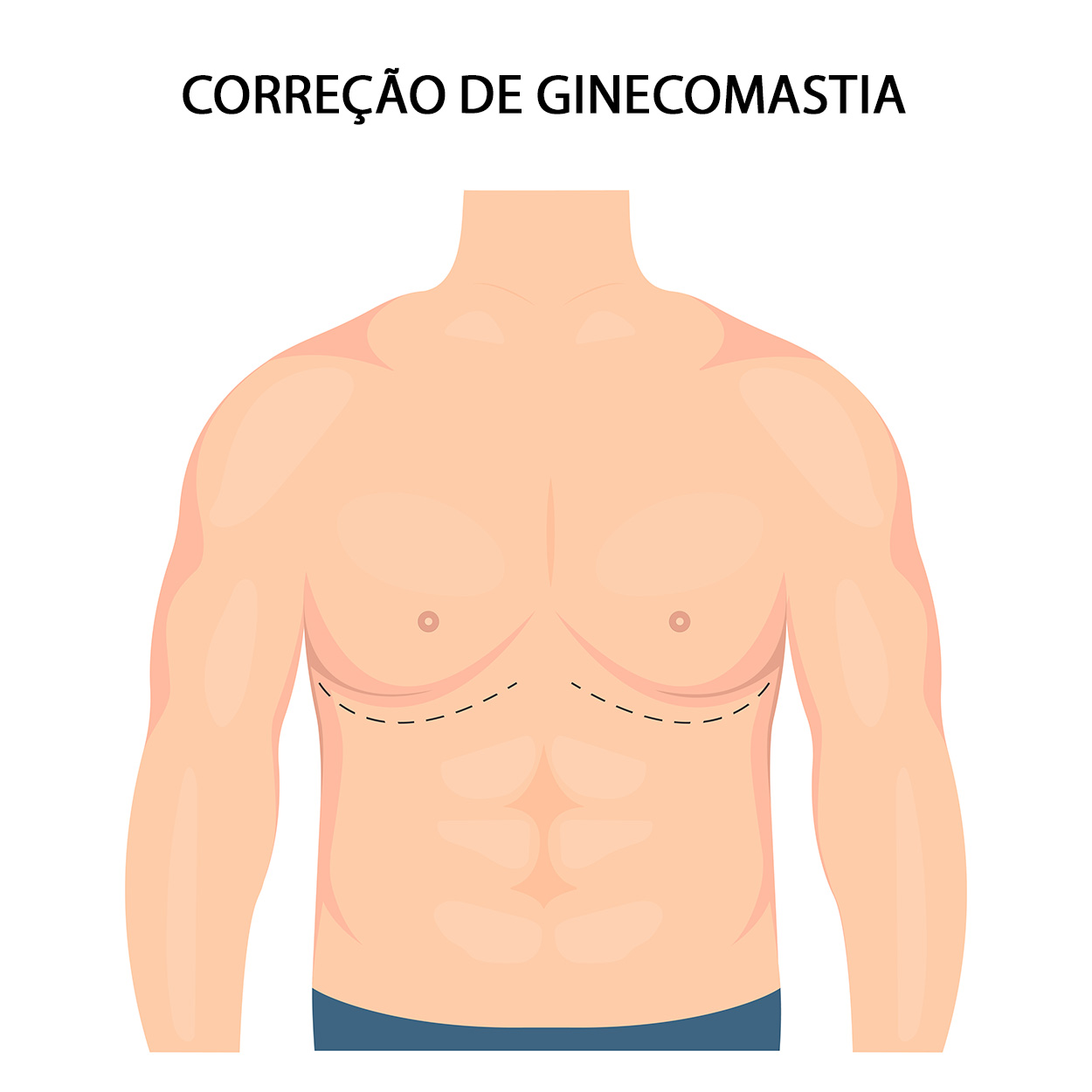 Mastopexia em L