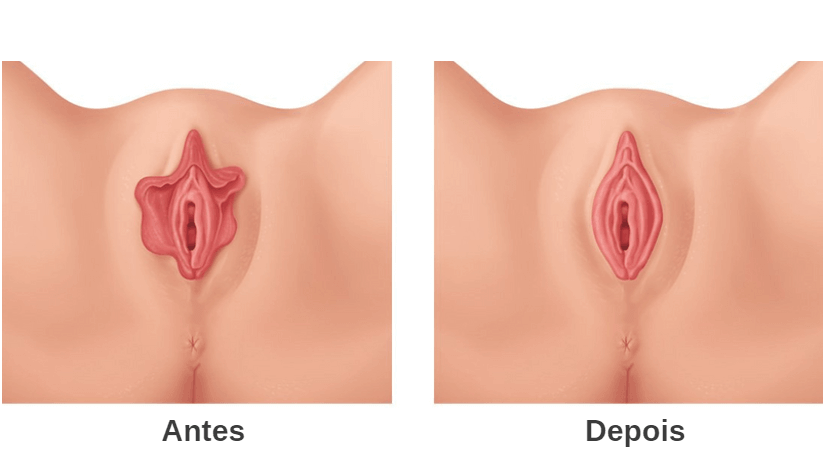 Mastopexia em L